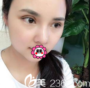 <!--<i data=20240703-sp></i>-->切開(kāi)雙眼皮假體隆鼻案例 <!--<i data=20240703-sp></i>-->切開(kāi)雙眼皮假體隆鼻案例