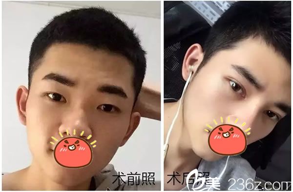 嘉興曙光阿爾法美眼案例效果 嘉興曙光阿爾法美眼案例效果