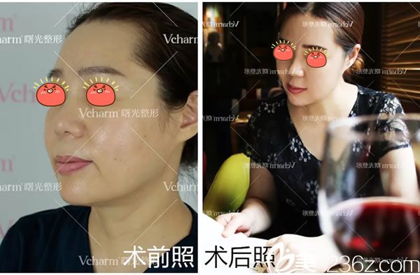 嘉興曙光4D線雕提拉逆齡案例效果 嘉興曙光4D線雕提拉逆齡案例效果