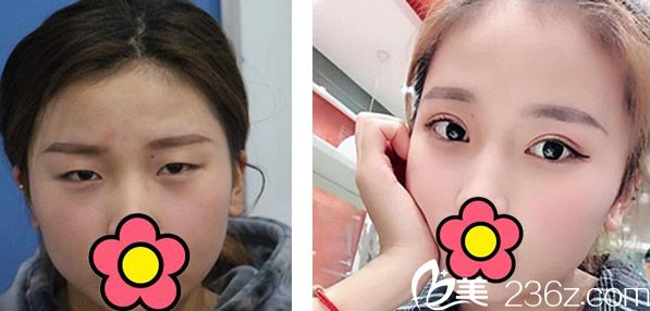 酒泉華美申志勇全切雙眼皮+開眼角效果案例 酒泉華美申志勇全切雙眼皮+開眼角效果案例