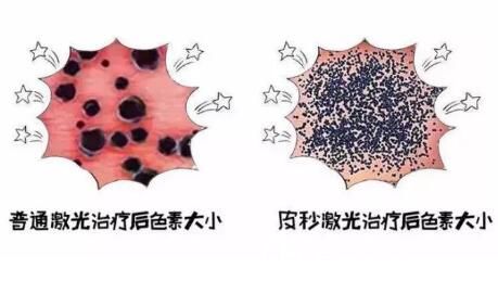  沈陽百嘉麗整形皮秒與傳統(tǒng)激光區(qū)別介紹