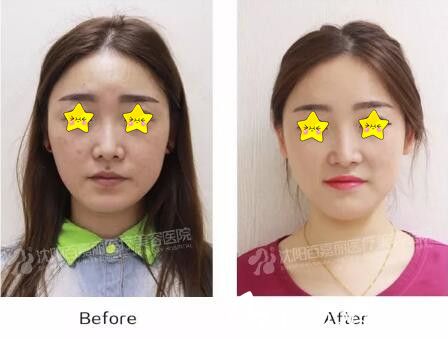 沈陽百嘉麗整形醫(yī)院蜂巢皮秒美膚真人前后對比效果