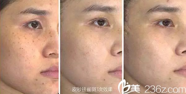 酒泉華美皮秒激光祛斑效果案例 酒泉華美皮秒激光祛斑效果案例