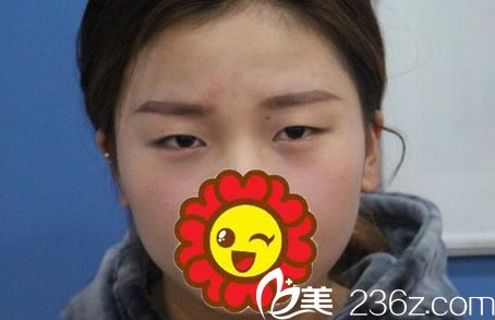 酒泉華美整形割雙眼皮前 酒泉華美整形割雙眼皮前