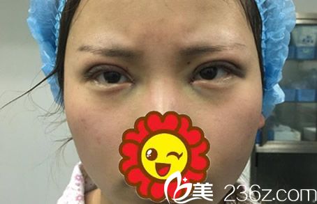 全切雙眼皮+開眼角天 全切雙眼皮+開眼角天