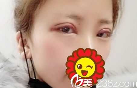 切開雙眼皮第二天眼睛很腫 切開雙眼皮第二天眼睛很腫