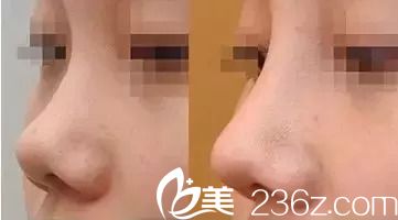 韓式SUS隆鼻案例 韓式SUS隆鼻案例