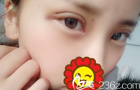 割雙眼皮第三天效果 割雙眼皮第三天效果