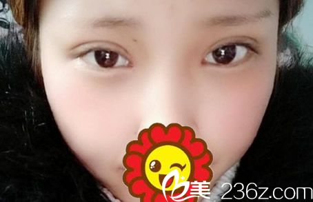 全切雙眼皮+開眼角第七天拆線后 全切雙眼皮+開眼角第七天拆線后