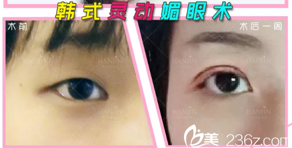 周創(chuàng)業(yè)雙眼皮案例