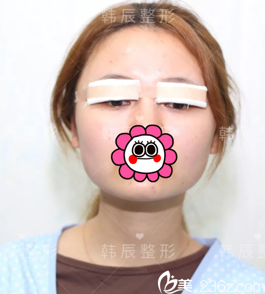 剛做完眼綜合整形手術(shù)