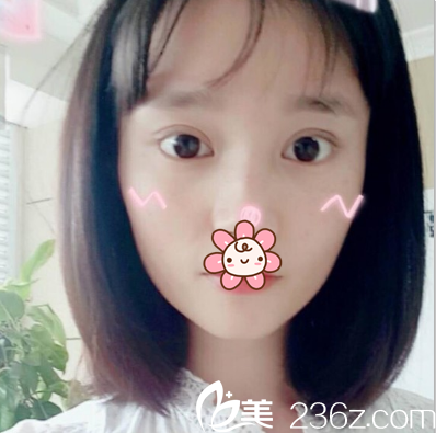 切開雙眼皮術(shù)后一個月恢復照片