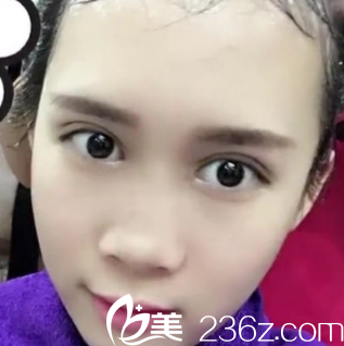 這是術(shù)前我的鼻子和短下巴 這是術(shù)前我的鼻子和短下巴