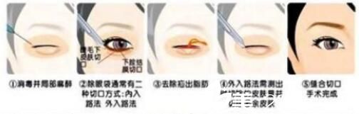 影響吸脂去眼袋價(jià)格的因素