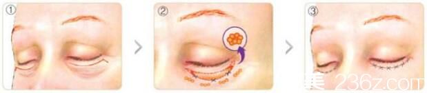 吸脂去眼袋效果好不好？