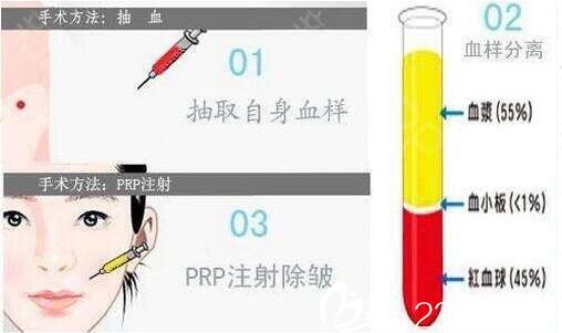  PRP自體血清注射除皺的四大原理