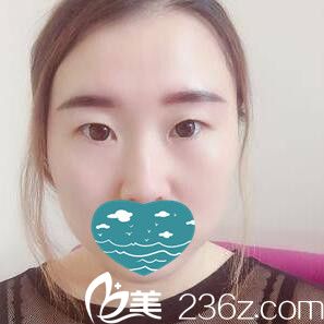 做眼綜合術(shù)前照 做眼綜合術(shù)前照