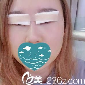 雙眼皮+開眼角術(shù)后即刻效果 雙眼皮+開眼角術(shù)后即刻效果