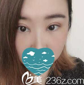 做雙眼皮+開眼角術(shù)后一周拆線 做雙眼皮+開眼角術(shù)后一周拆線