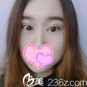 在丹東做雙眼皮+開眼角術(shù)后半個月情況 在丹東做雙眼皮+開眼角術(shù)后半個月情況