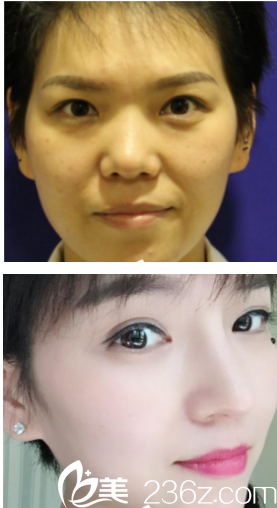 西安葉子截骨手術(shù)+肋軟骨隆鼻+鼻小柱手術(shù)案例