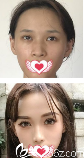 西安葉子膨體隆鼻+鼻翼收縮+自體耳軟骨隆鼻尖真人案例