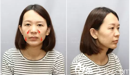 對比了深圳美萊和陽光整形醫(yī)院的價格后找張起準(zhǔn)做了6d面部埋線