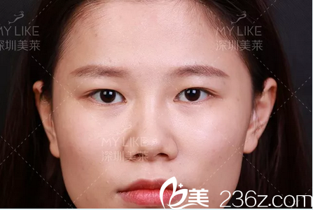在深圳美萊做雙眼皮隆鼻手術(shù)前 在深圳美萊做雙眼皮隆鼻手術(shù)前