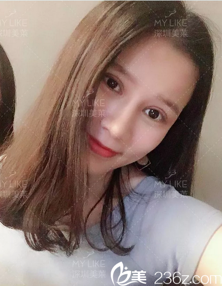 深圳美萊陳磊做的雙眼皮隆鼻案例圖片 深圳美萊陳磊做的雙眼皮隆鼻案例圖片