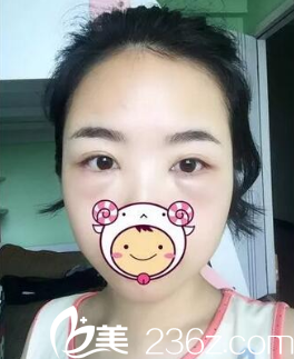 阜陽去眼袋哪家好？阜陽東方美萊塢術(shù)后真實(shí)恢復(fù)照片