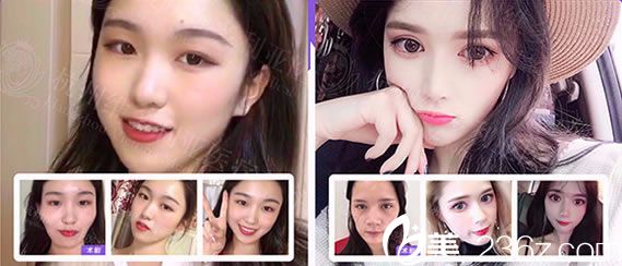 杭州維多利亞自體脂肪填充案例