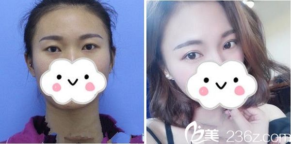 贛州華美整形醫(yī)院雙眼皮手術(shù)案例