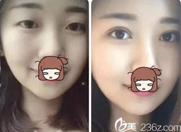 贛州亞韓雙眼皮手術(shù)案例