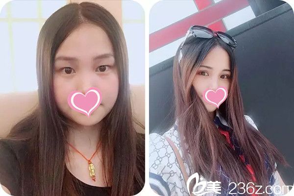 贛州長安整形雙眼皮手術(shù)案例