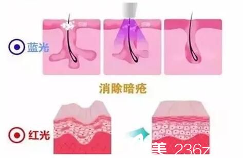 紅藍(lán)光祛痘做一次有效果嗎?