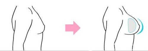 假體隆胸的價格于哪些因素有關(guān)