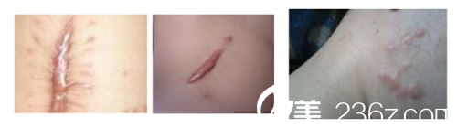 疤痕增生的表現(xiàn)