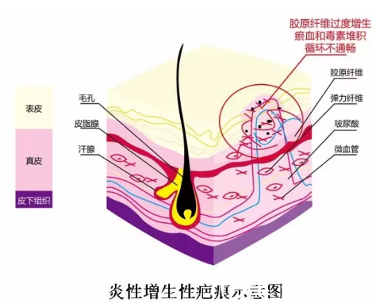 增生性疤痕形成原因