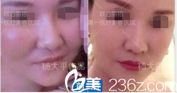 北京聯合麗格楊大平臉部生長因子取出修復案例 北京聯合麗格楊大平臉部生長因子取出修復案例