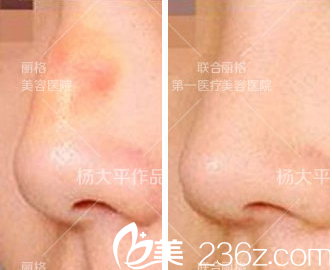 北京聯合麗格楊大平微晶瓷注射物取出+鼻修復案例 北京聯合麗格楊大平微晶瓷注射物取出+鼻修復案例