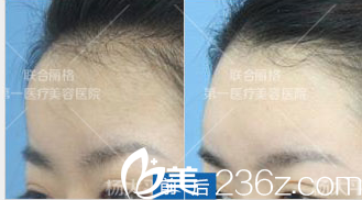 北京聯合麗格楊大平額頭生長因子取出案例 北京聯合麗格楊大平額頭生長因子取出案例
