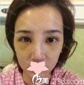 安徽韓美整形注射物取出+隆鼻失敗修復(fù)第7天拆線圖 安徽韓美整形注射物取出+隆鼻失敗修復(fù)第7天拆線圖