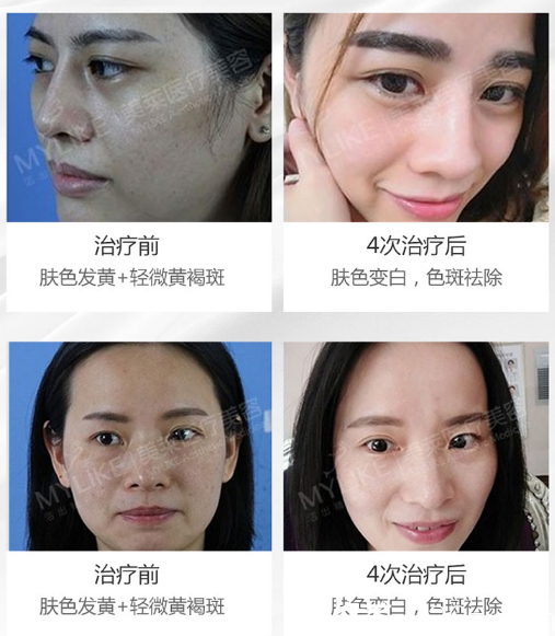 佛山美萊王晶瑜做的超皮秒祛斑效果圖 佛山美萊王晶瑜做的超皮秒祛斑效果圖