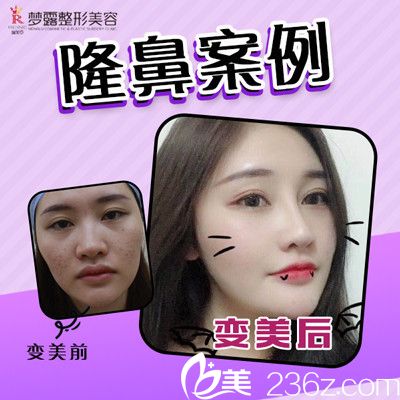 佛山夢露整形醫(yī)院隆鼻案例對比圖 佛山夢露整形醫(yī)院隆鼻案例對比圖