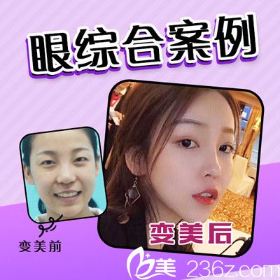 佛山夢露整形醫(yī)院孫文娜醫(yī)生做的雙眼皮案例 佛山夢露整形醫(yī)院孫文娜醫(yī)生做的雙眼皮案例
