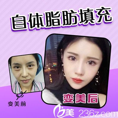 佛山夢露游萬福做的自體脂肪面部填充案例 佛山夢露游萬福做的自體脂肪面部填充案例