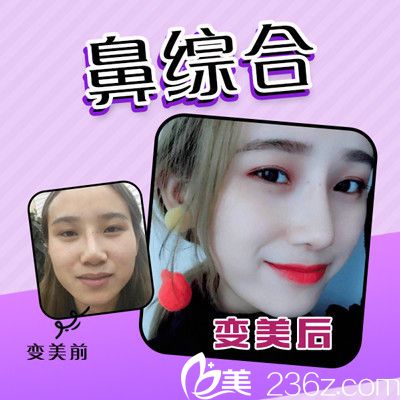 佛山夢露整形醫(yī)院游萬福做的鼻綜合隆鼻案例 佛山夢露整形醫(yī)院游萬福做的鼻綜合隆鼻案例
