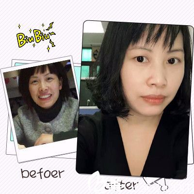 佛山夢露整形醫(yī)院除皺案例 佛山夢露整形醫(yī)院除皺案例