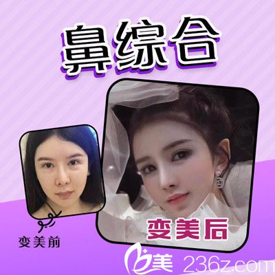 佛山夢露游萬福做的隆鼻失敗修復案例 佛山夢露游萬福做的隆鼻失敗修復案例