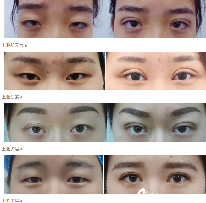 劉非醫(yī)生雙眼皮手術案例 劉非醫(yī)生雙眼皮手術案例